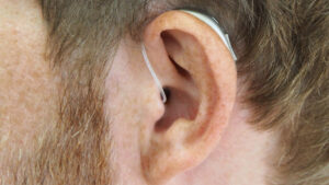 An ear with a colloquial hearing implant.